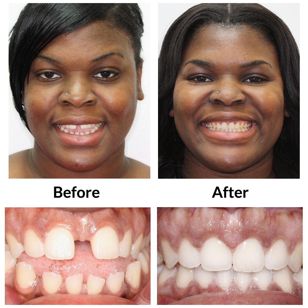 Invisalign Patient Photo 1