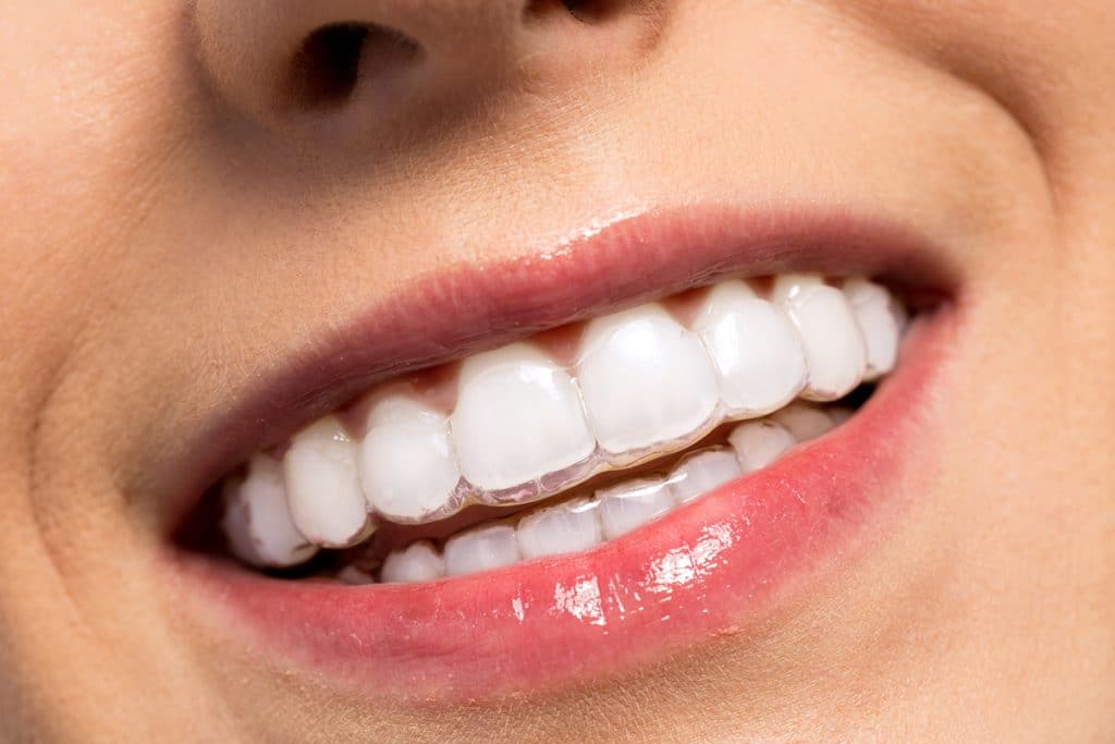 Can Invisalign Fix An Underbite?