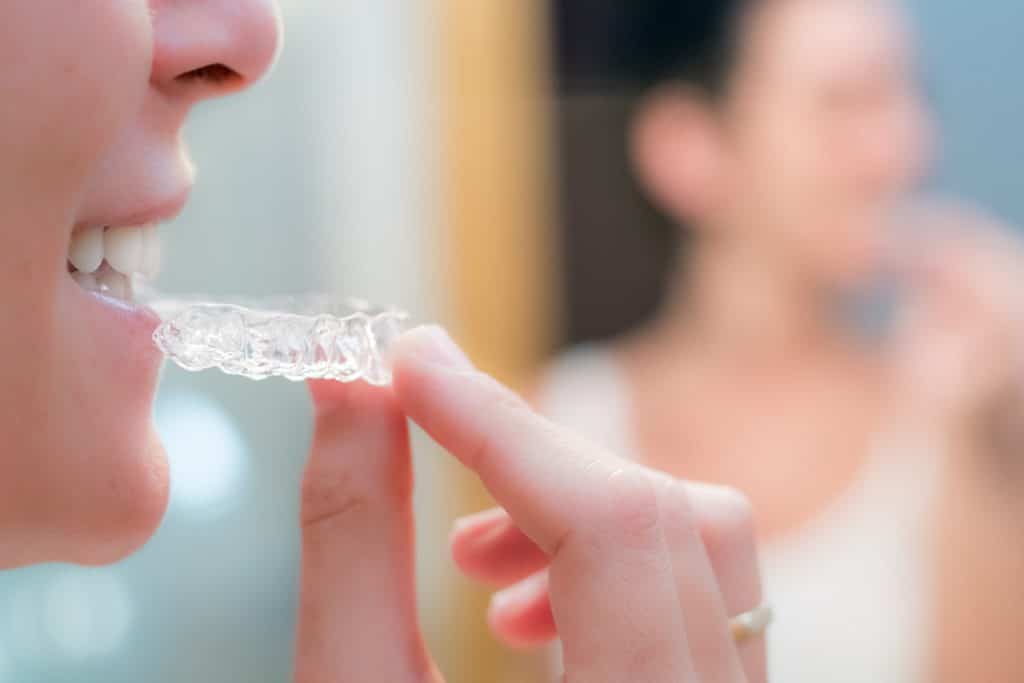 How Does Invisalign Work?