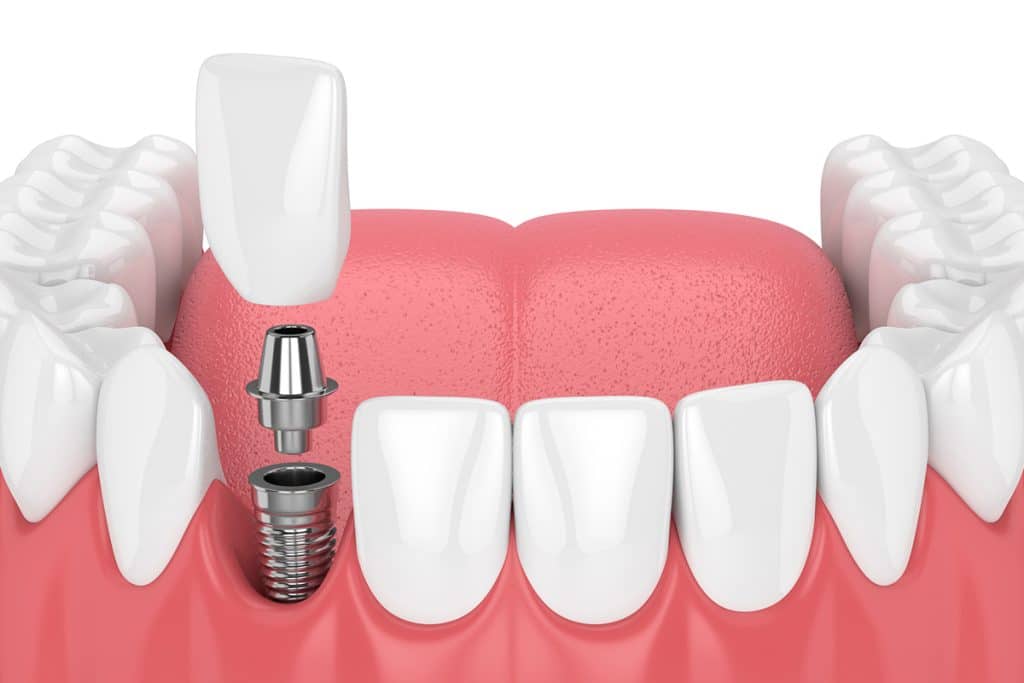 What Are The Benefits Of Dental Implants?